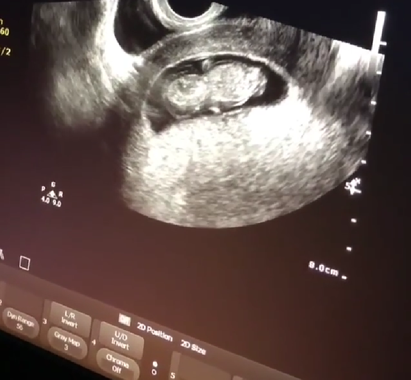 Joanna Gaines' Ultrasound Raised Son Crew Gaines Disability Rumor